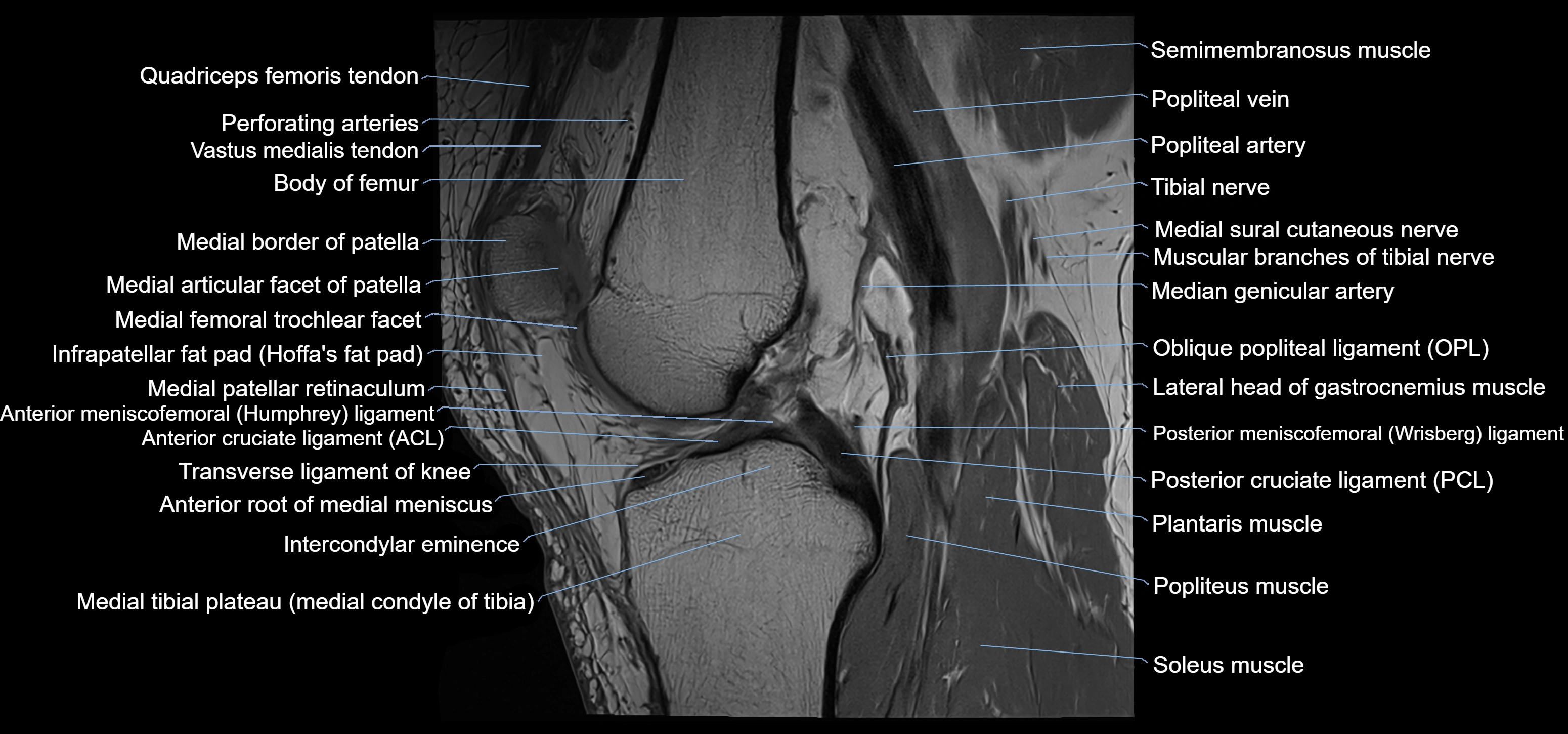 MRI knee sagittal cross sectional anatomy labelled 3T radiology image-00025.webp